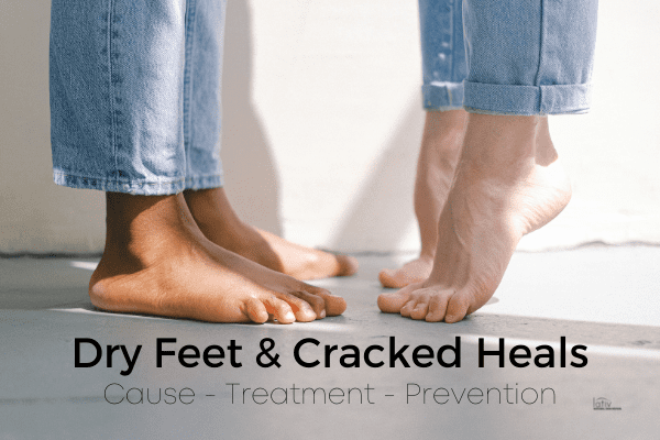 How to heal your heels for flip-flop season • Binkies and Briefcases | Dry  cracked feet, Cracked feet, Cracked heel remedies